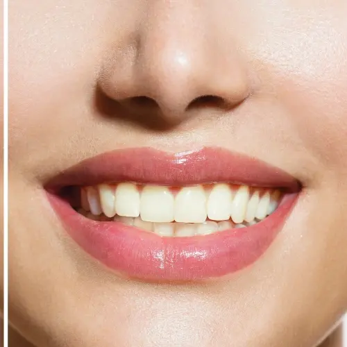 Before and After Teeth Whitening Treatment - Revive Dental